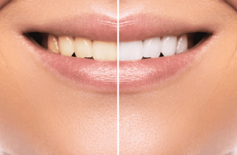 Teeth Whitening Options: Which One Is Right for You?