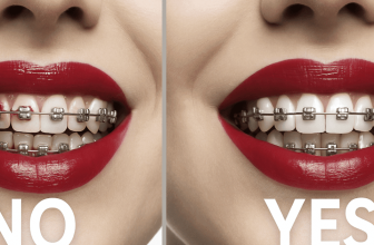 How To Wear Lipstick With Braces As An Adult